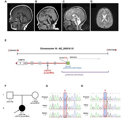 Novel bi-allelic variants of CHMP1A contribute to pontocerebellar hypoplasia type 8: additional clinical and genetic evidence